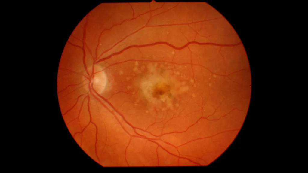 Retinal fundus image showing signs of macular degeneration.