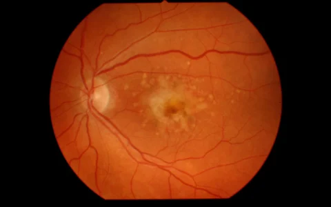 Retinal fundus image showing signs of macular degeneration.