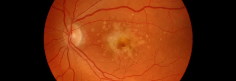 Retinal fundus image showing signs of macular degeneration.