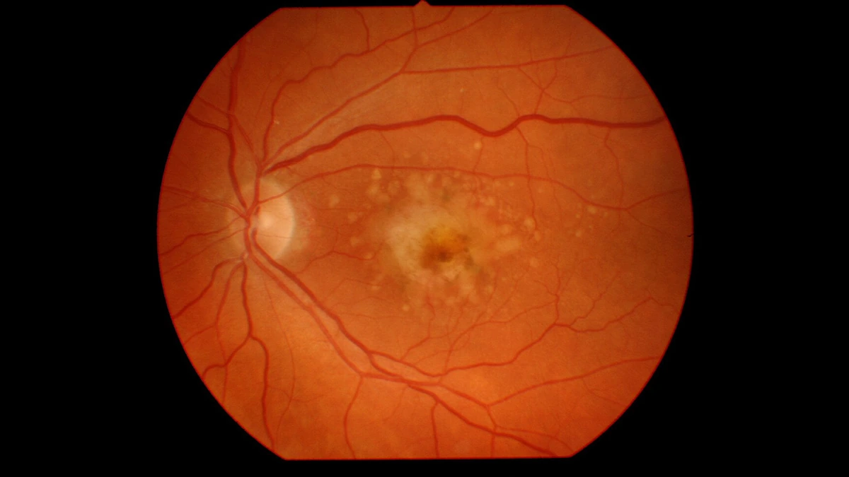 Retinal fundus image showing signs of macular degeneration.